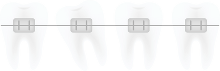 Correction of teeth with orthodontic braces