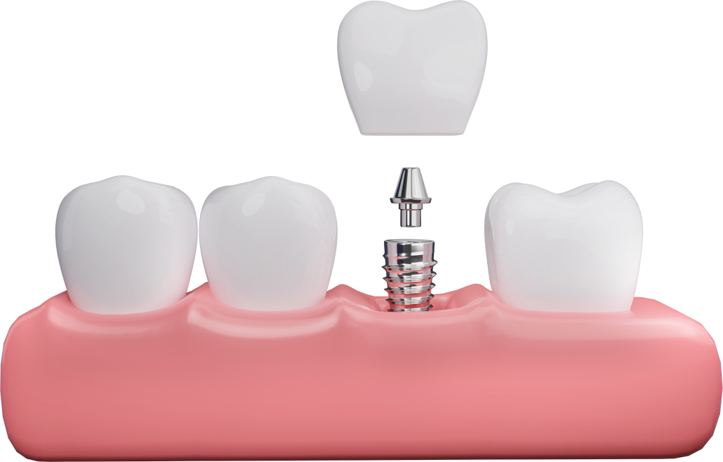 Dental implant with tooth and gums